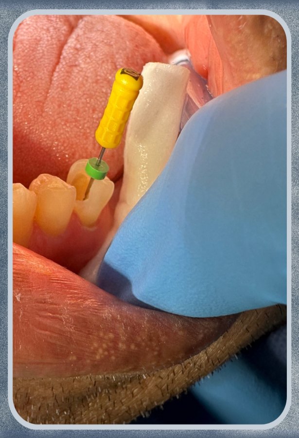 Endodoncia